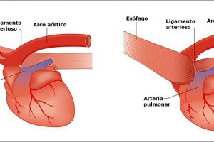 Arco aórtico derecho persistente AADP