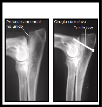 Proceso anconeal no unido - corrección